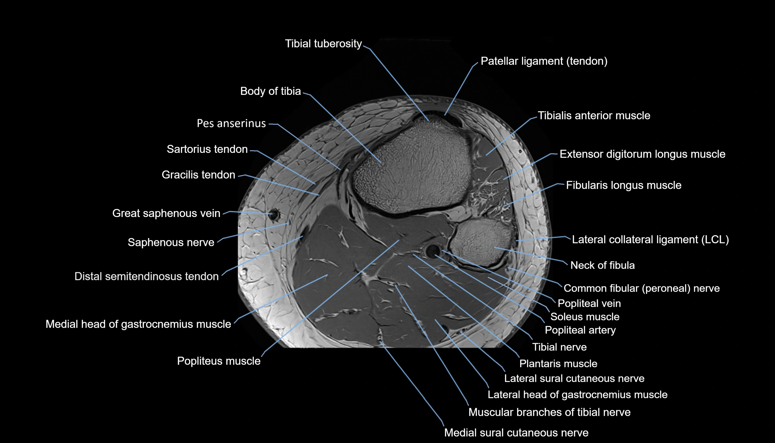 MRI knee  axial cross sectional anatomy 3T radiology  image-img-00001-00045.webp